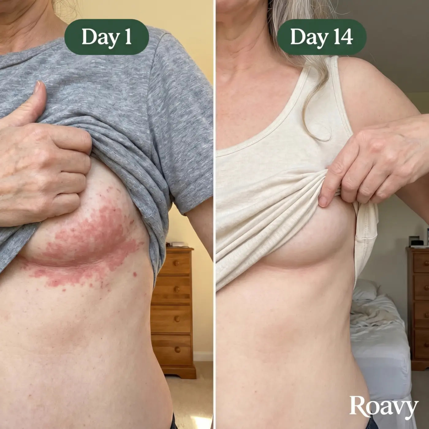 Roavy™ Intertrigo Relief Cream