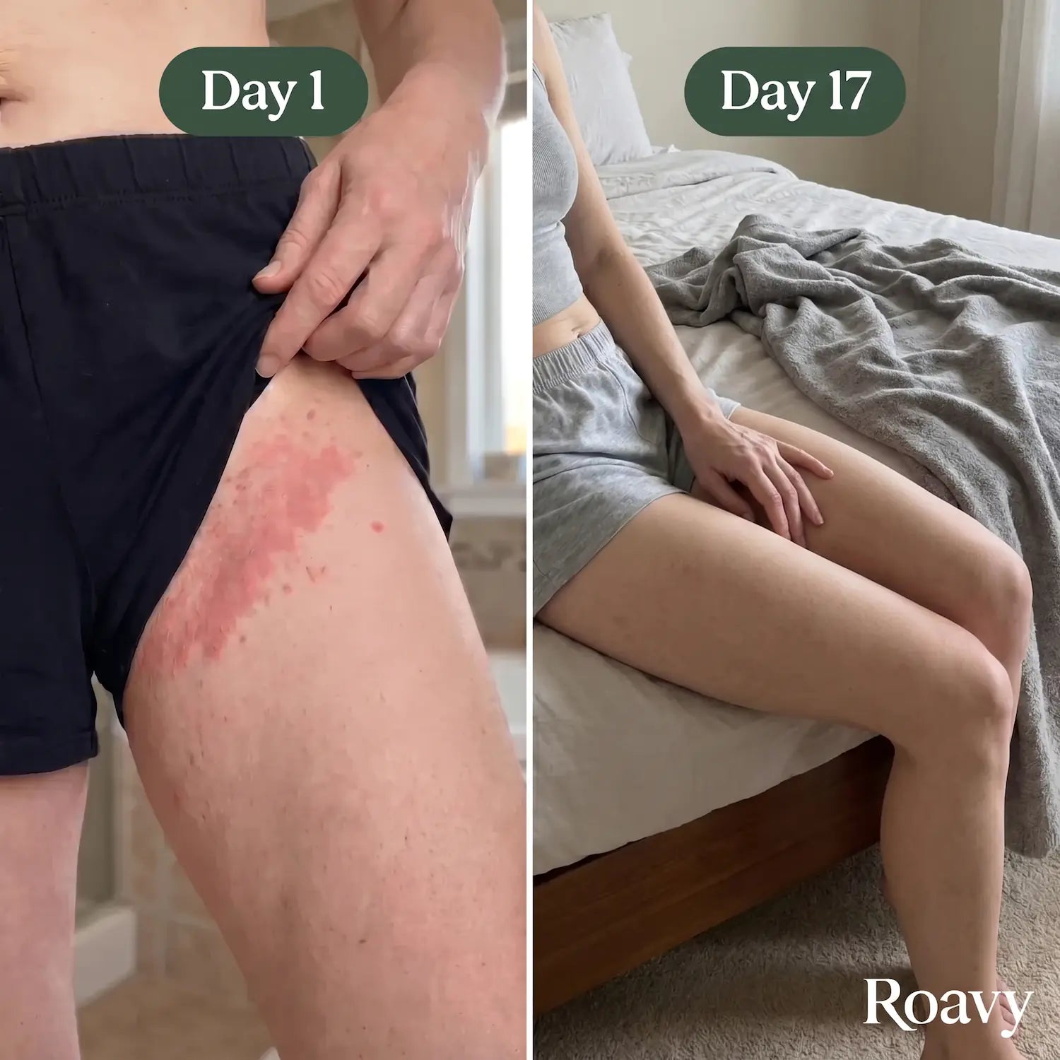 Roavy™ Intertrigo Relief Cream